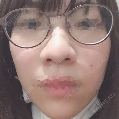 隆鼻術 / 鼻尖形成（切開） / 小鼻縮小（切開） 湘南美容クリニック 岡山院 AFTER