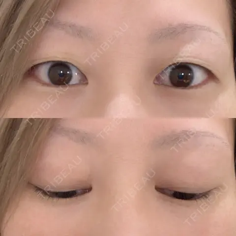 二重埋没 かじクリニック 熊本 AFTER