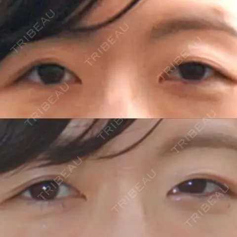 二重切開 城本クリニック 長崎院 AFTER