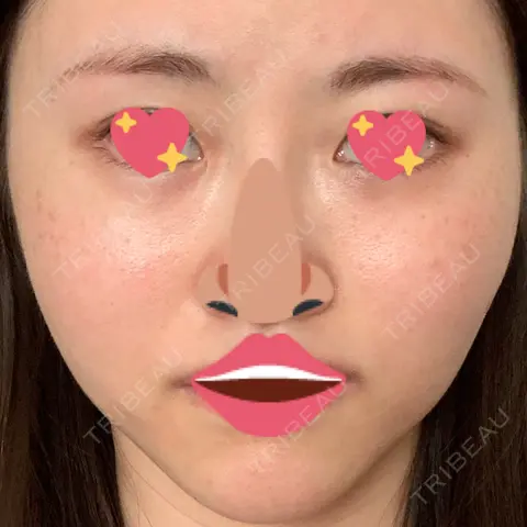 ルビーレーザー 南青山TOKUNAKAクリニック AFTER