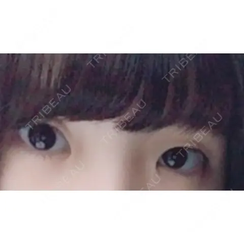 二重埋没 / 目頭切開 品川美容外科 千葉院 AFTER