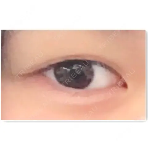 二重埋没 青森タウン形成外科クリニック AFTER