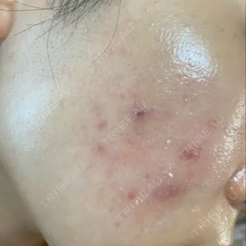 ダーマペン NI MEDICAL CLINIC AFTER