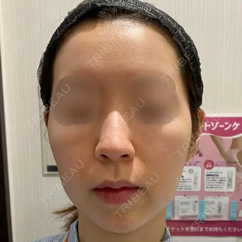 糸リフト 湘南美容クリニック 渋谷院 AFTER