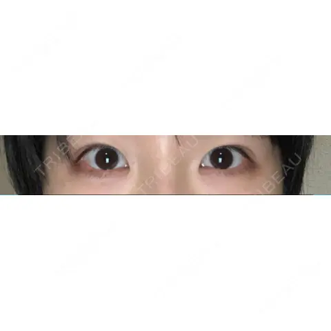 目頭切開 / タレ目形成・グラマラスライン（切開） / ヒアルロン酸注入（涙袋） 東京エビスクリニック AFTER