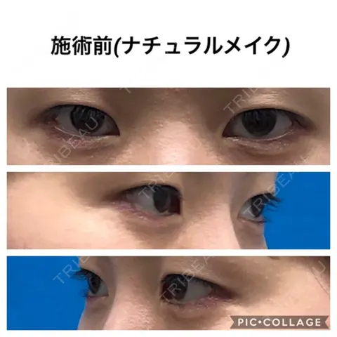 二重埋没 / 目頭切開 / 上まぶたの脂肪取り TCB東京中央美容外科 仙台駅前院 AFTER