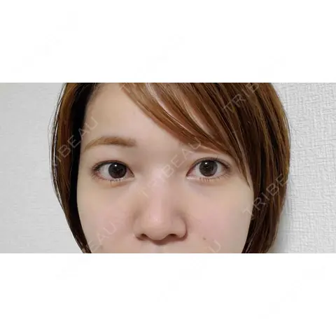 鼻尖形成（切開） / 鼻中隔延長（切開） / クマ治療 / 軟骨移植 R Beauty CLINIC 銀座院 AFTER