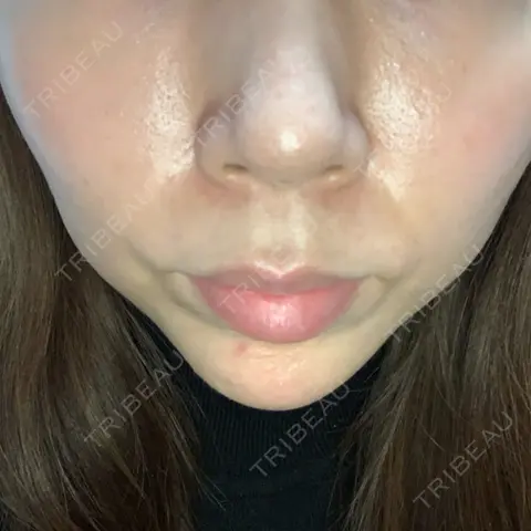 糸リフト ノーチェビューティクリニック AFTER