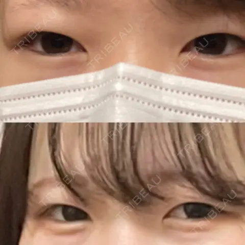 二重切開 水の森美容クリニック 東京銀座院 AFTER