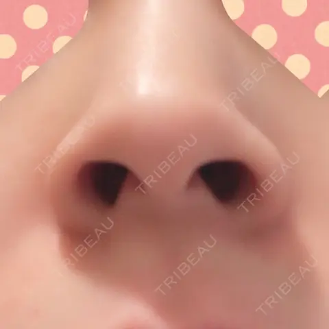 小鼻縮小（切開） 湘南美容クリニック 秋葉原院 AFTER