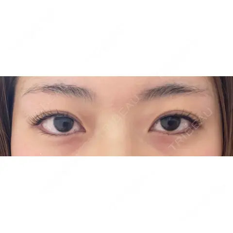 二重埋没 / 目尻切開 / 上まぶたの脂肪取り / タレ目形成・グラマラスライン（切開） A CLINIC（エークリニック） 銀座院 AFTER