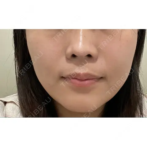 白玉点滴・注射 銀座TSUBAKIクリニック AFTER