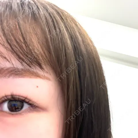 ほくろ・いぼ除去レーザー（首） ルラ美容クリニック 大宮院 AFTER