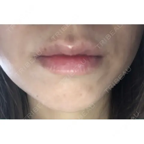 ボトックス（あご） / ボトックス（エラ・小顔） / ヒアルロン酸注入（唇） / ボトックス（口角） / ボトックス（人中） アリエル美容クリニック 大宮院 AFTER