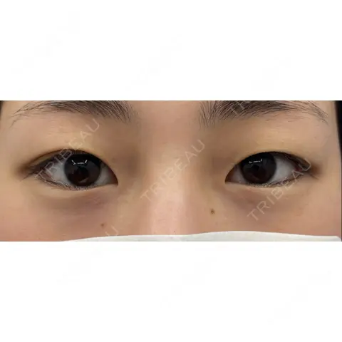 二重埋没 / 目頭切開 / 上まぶたの脂肪取り 湘南美容クリニック 上野院 AFTER