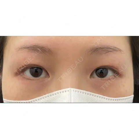 二重埋没 / 上まぶたの脂肪取り 湘南美容クリニック 上野院 AFTER