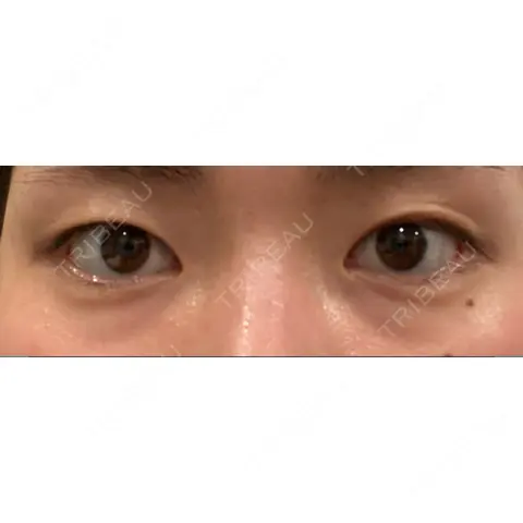 二重埋没 湘南美容クリニック 上野院 AFTER