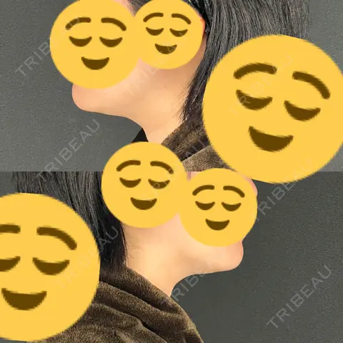 脂肪吸引（顔） MYCLI【マイクリ】東京・恵比寿院 AFTER