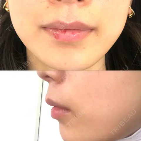 ヒアルロン酸注入（唇） / ボトックス（口角） MSC LUNA CLINIC 渋谷院 AFTER