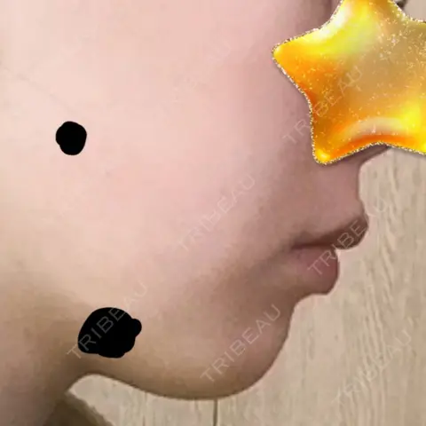 ボトックス（あご） 湘南美容クリニック 札幌院 AFTER