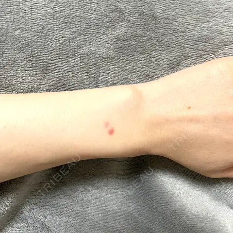 ほくろ・いぼ切除（肌） 美容皮膚科エルムクリニック 京都院 AFTER