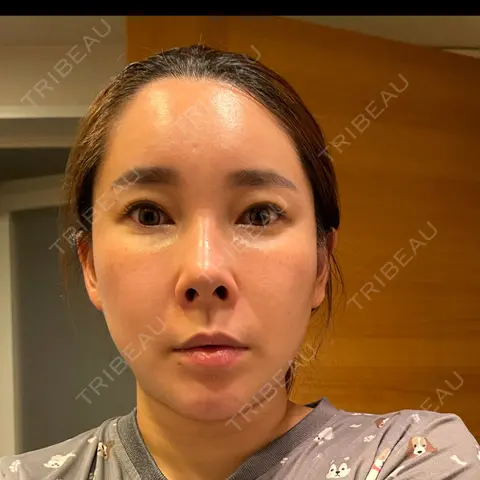ヴェルヴェットスキン MSC LUNA CLINIC 渋谷院 AFTER
