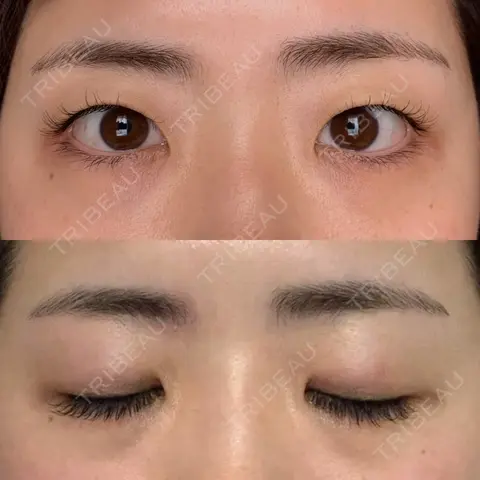 二重埋没 EMMA CLINIC（エマクリニック） BEFORE