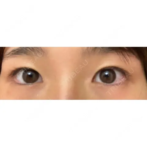 二重切開 / 目頭切開 / 眼瞼下垂（切開） いちのせ形成外科・皮膚科 眼瞼＆フェイスクリニック AFTER