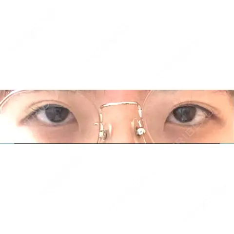 二重切開 / 目頭切開 / 眼瞼下垂（切開） いちのせ形成外科・皮膚科 眼瞼＆フェイスクリニック AFTER