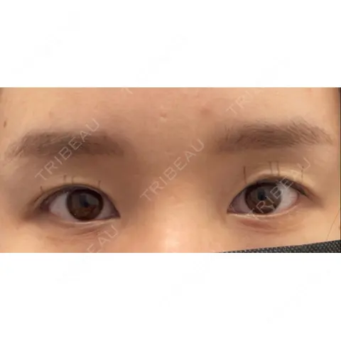 二重埋没 湘南美容クリニック 熊本院 AFTER