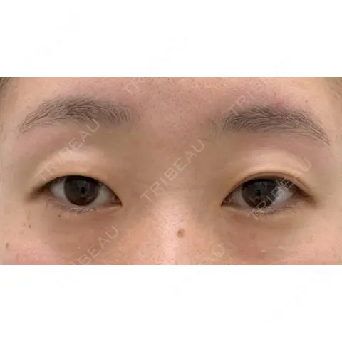 二重埋没 EMMA CLINIC（エマクリニック） BEFORE