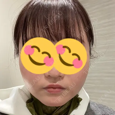 ボトックス（エラ・小顔） / ボトックス（口角） AILE Clinic AFTER