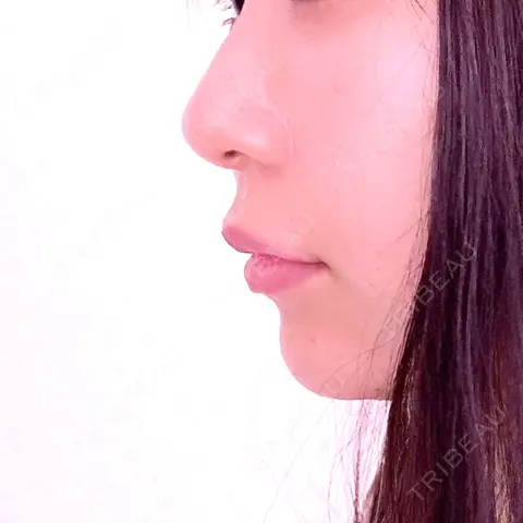 ヒアルロン酸注入（あご） MSC LUNA CLINIC 渋谷院 AFTER