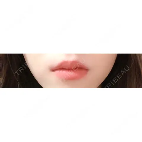 ヒアルロン酸注入（唇） / ボトックス（口角） MSC LUNA CLINIC 渋谷院 AFTER