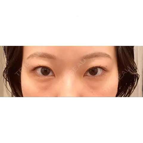 下まぶたの脂肪取り APOLLO BEAUTY CLINIC BEFORE