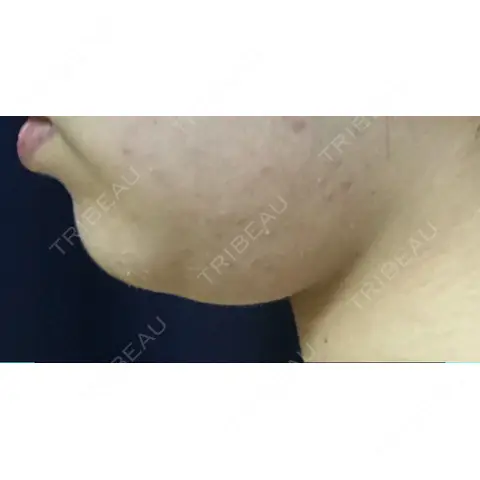 脂肪溶解注射（顔） 東京ロイヤルクリニック AFTER