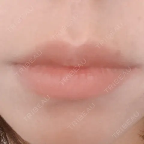 ボトックス（人中） AILE Clinic AFTER