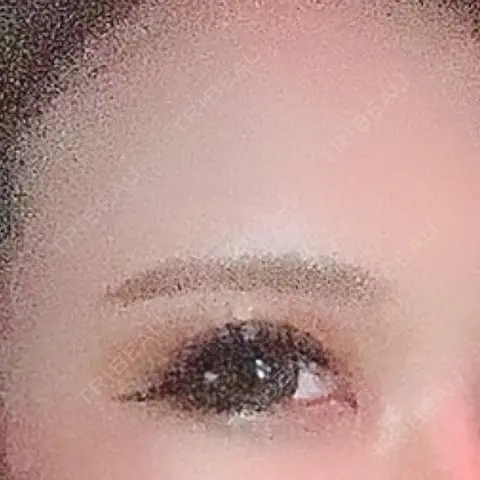 二重埋没 / その他（目元） 東京BELLEZZAクリニック AFTER