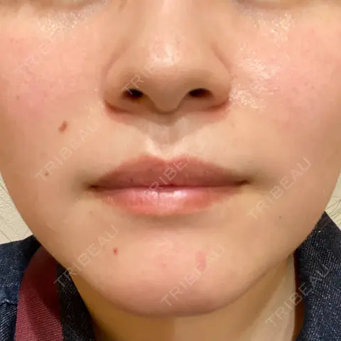 ダーマペン / 毛穴洗浄（ハイドラフェイシャルなど） まゆりなclinic 名古屋栄 AFTER