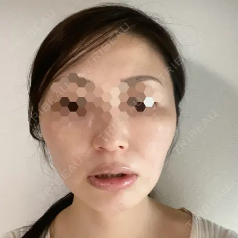 糸リフト oggi clinic AFTER