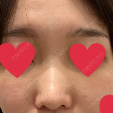ヒアルロン酸注入（鼻） アクトリー勝どきウェルネスメディカルクリニック AFTER