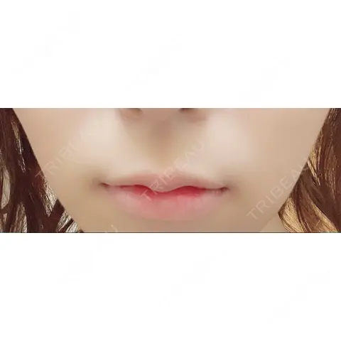 ボトックス（あご） / ヒアルロン酸注入（唇） / ボトックス（口角） / ボトックス（人中） MAe Clinic 東京院 AFTER