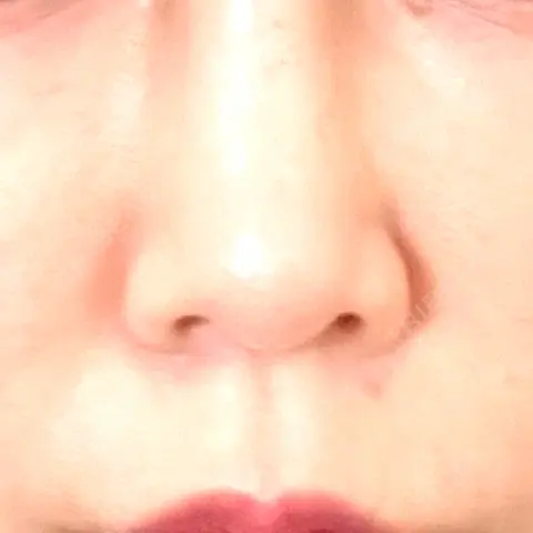 小鼻縮小（切開） / 鼻翼挙上 MIL CLINIC OSAKA AFTER