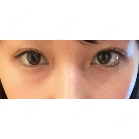 クマ治療 / 下まぶたの脂肪取り APOLLO BEAUTY CLINIC AFTER