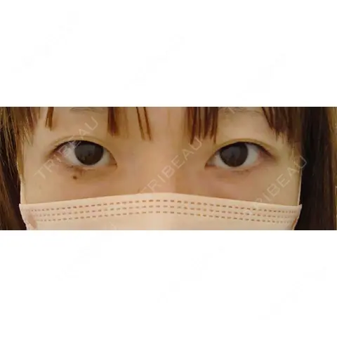 二重埋没 東郷美容形成外科 福岡 AFTER