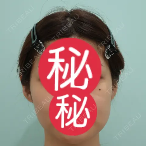 脂肪吸引（顔） / ボトックス（エラ・小顔） / 脂肪注入（輪郭） WOM CLINIC GINZA （ワム クリニック ギンザ） BEFORE