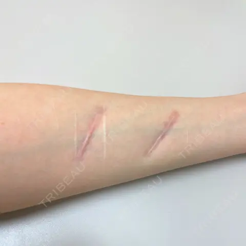 傷跡修正 郡山タウン形成外科クリニック AFTER