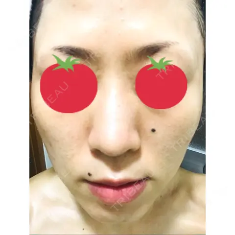 ピーリング（ニキビ・毛穴） / イオン導入 / フォトシルクプラス / 光治療（フォトフェイシャルなど） / ウーバーピール / ニキビ治療 / その他（肌） ハニークリニック AFTER