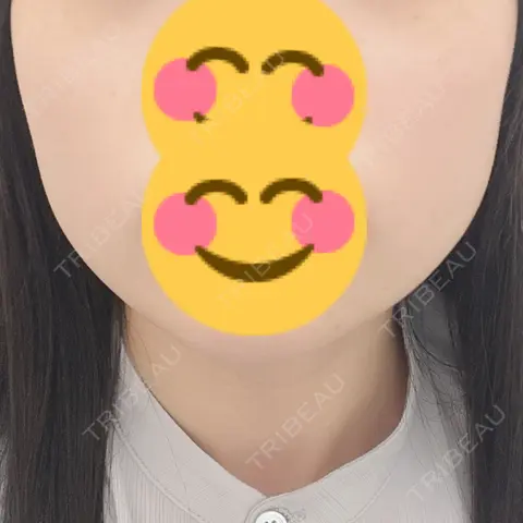 ボトックス（エラ・小顔） TCB東京中央美容外科 高崎院 AFTER