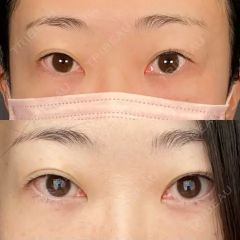 二重切開 / 上まぶたたるみ取り / PRP皮膚再生療法 BRIGHTS beauty clinic AFTER